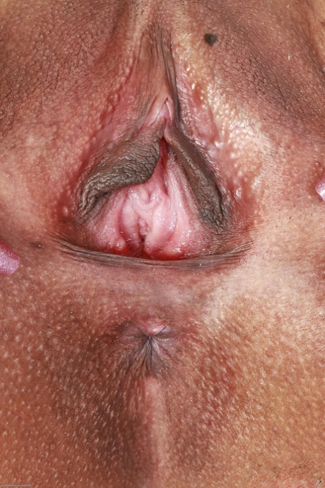 Brazzilian Acne xxx pics